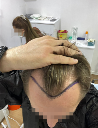 przed przeszczepem włosów nielegalna klinika