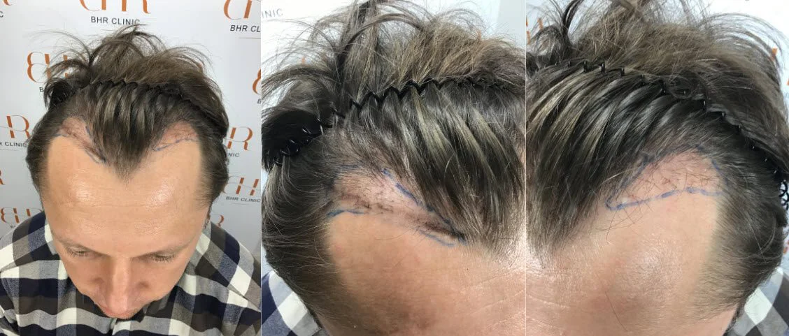 14 miesięcy po naprawie przeszczepu włosów
